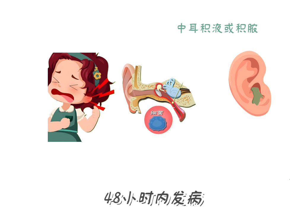 急性中耳炎2(1).png