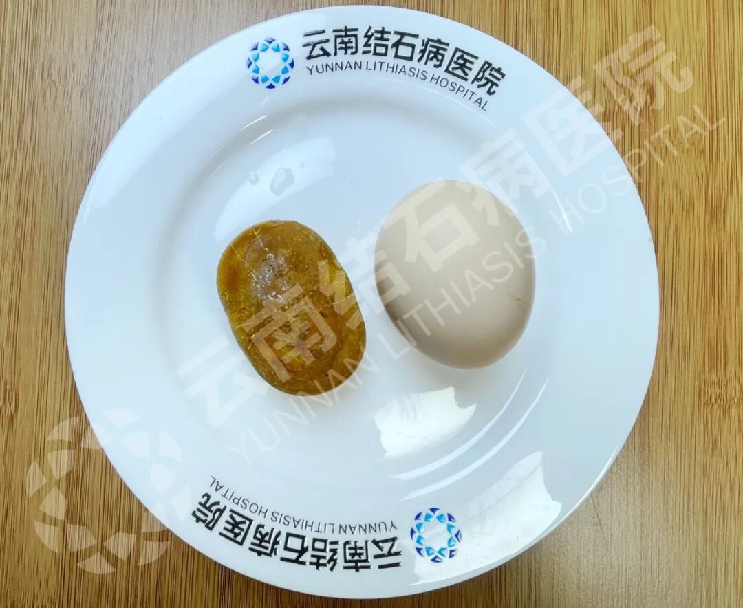 膀胱结石.jpg