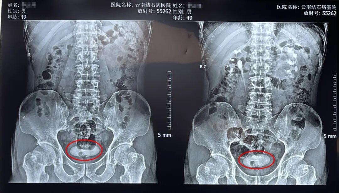 膀胱结石1.jpg