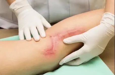 丽合疤痕修复 全心守护治疗安全