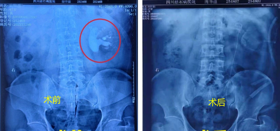 左肾积水怎么检查 1705890681965184.png