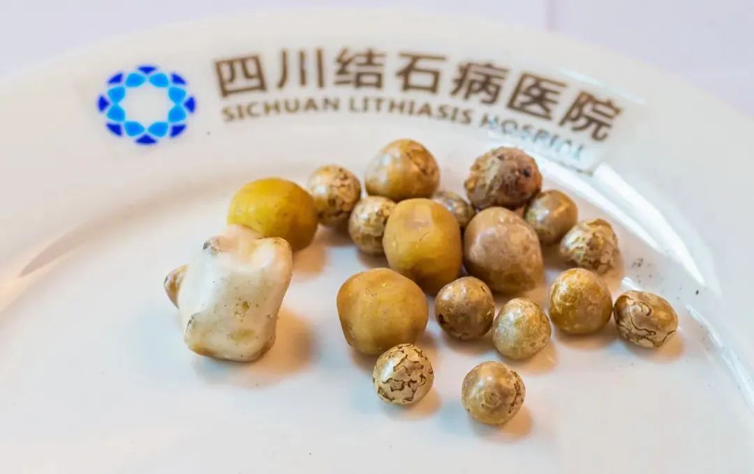四川结石病医院案例分享：孩子的胆囊保住了，太感谢你们了！