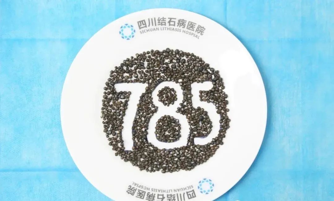 成都胆结石专科医院在哪里？大邑医生胆囊藏785颗结石，来我院成功保胆取石！